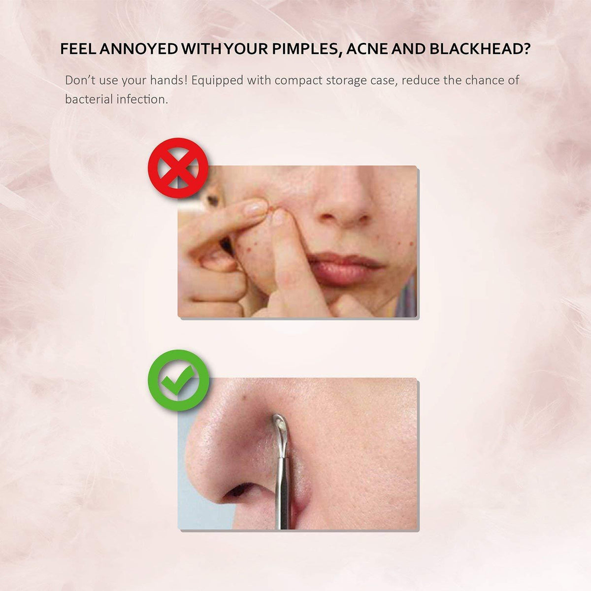 Mitesserentferner Set | Blackhead Remover aus Edelstahl | 6 Stk. Komedonenquetscher Kit