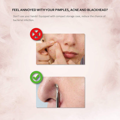 Mitesserentferner Set | Blackhead Remover aus Edelstahl | 6 Stk. Komedonenquetscher Kit