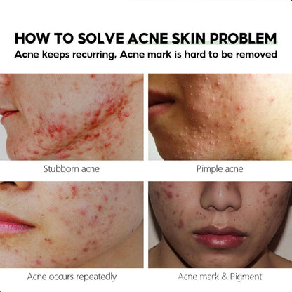 Herbal Anti-Akne Serum und Creme Set Natürliche Pflege